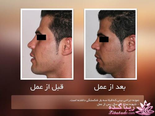 جراحی بینی - جراحی زیبایی